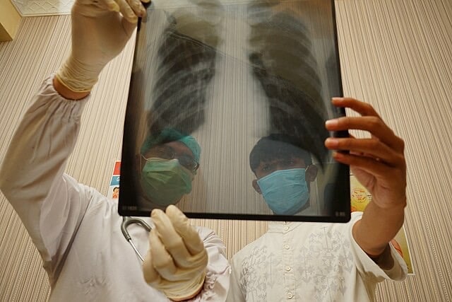 North East Sees Sharp Rise in TB Cases as England Records Regional Variations in 2025